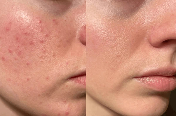 DermaSmooth Skin Tag Remover Original Patch - Painless Patch for Acne & skin tag